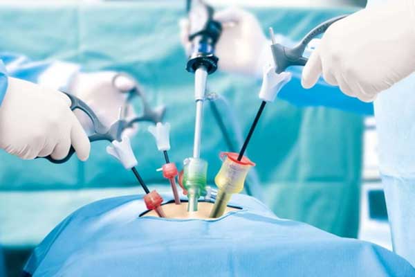 Benefits of Laparoscopic Gallbladder Surgery