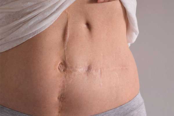Recovery After Gallbladder Removal Surgery