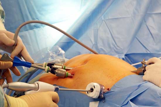 Lap Hernia