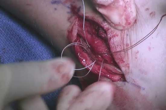 Tubulization