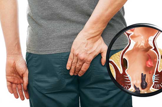Haemorrhoids