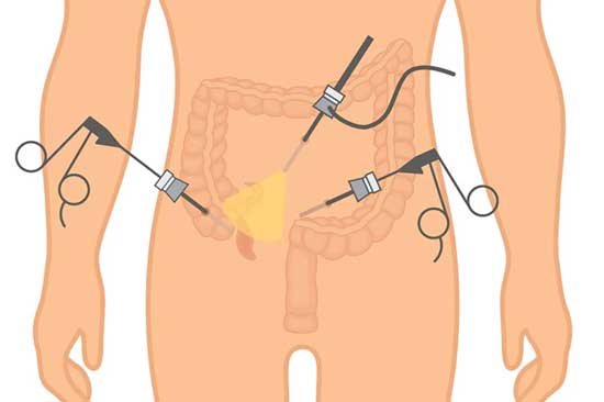 Lap Appendix