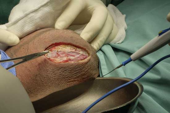 hydrocele