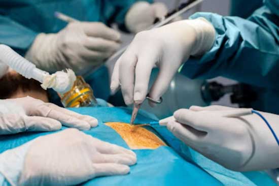 Open Hernia